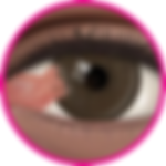 PTERYGIUM Eye hospital